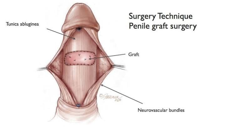 Surgical diagram of penile graft surgery, with the tunica albuginea opened, the neurovascular bundles retracted to either side, and a graft sutured into the tunical defect left after plaque incision.