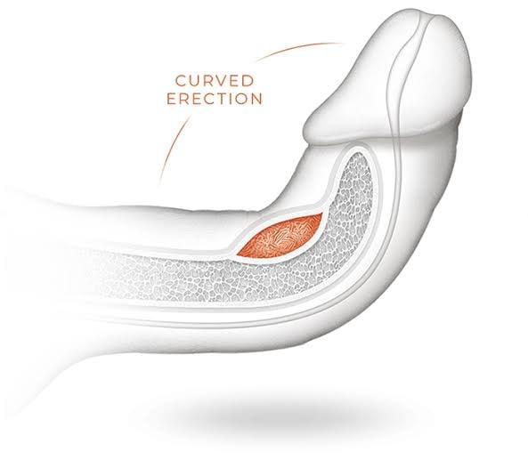 Cross-section diagram of an erect penis in Peyronie’s disease, showing the fibrous plaque in the tunica albuginea on the upper surface and the resulting upward curve of the shaft.